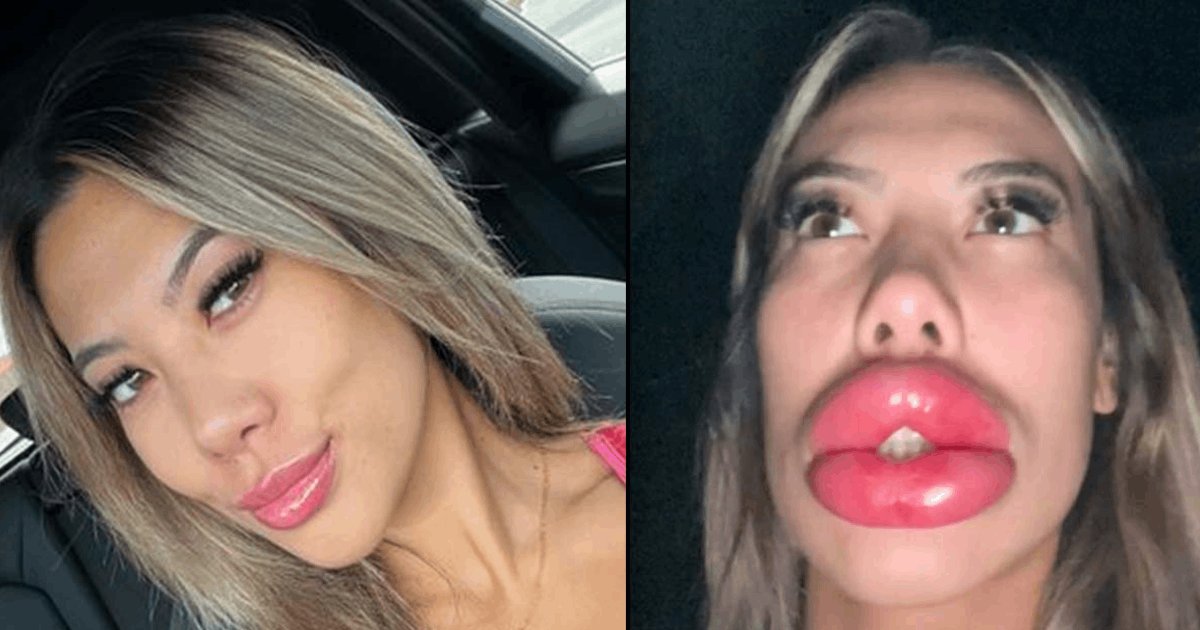 t5 16.png?resize=412,232 - EXCLUSIVE: Woman Shares Devastating Warning After Lip Fillers Go HORRIBLY Wrong
