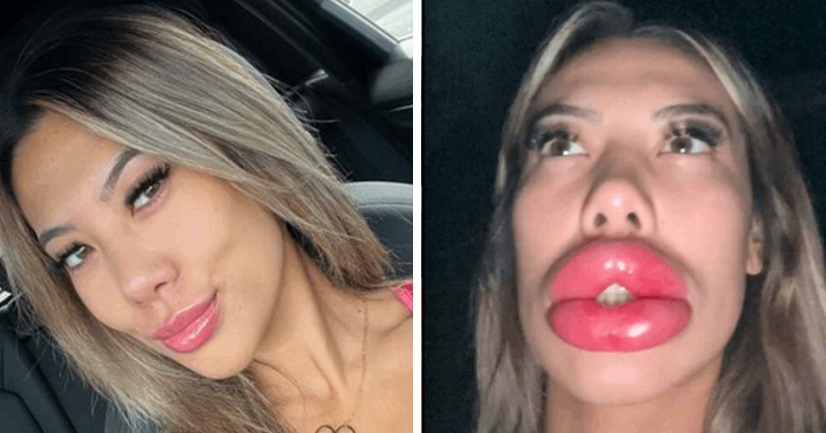 t2 29.png?resize=1200,630 - EXCLUSIVE: Lip Filler Procedure Goes Horribly Wrong As Woman Left With 'Embarrassing' Face
