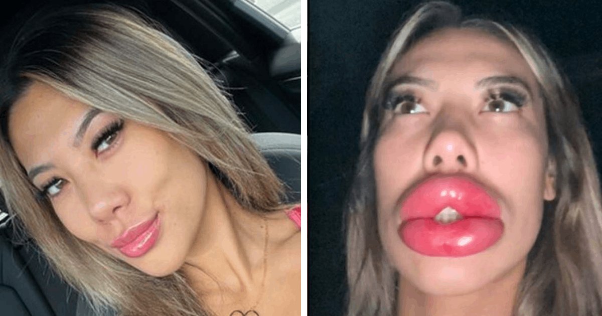 t2 29.png?resize=412,275 - EXCLUSIVE: Lip Filler Procedure Goes Horribly Wrong As Woman Left With 'Embarrassing' Face