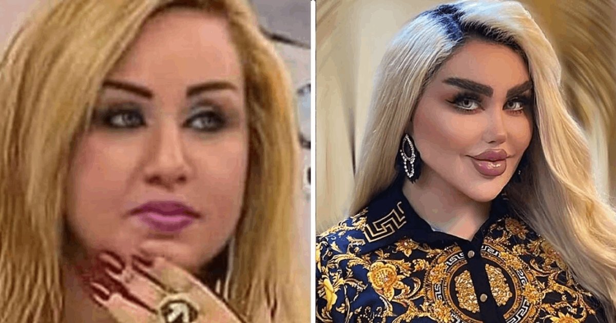 t6 30 1.png?resize=412,275 - EXCLUSIVE: Woman Has 43 Cosmetic Procedures In Hopes Of Being A Barbie But Ends Up Looking Like A Zombie