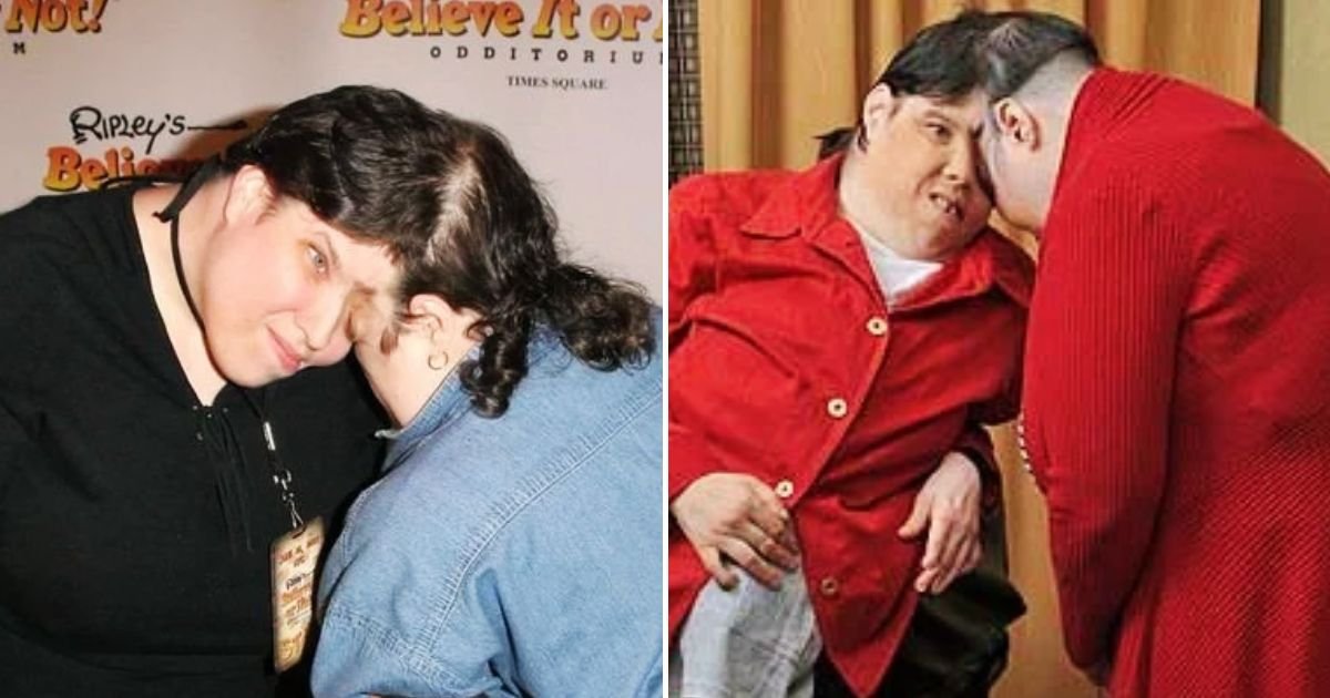 twins4.jpg?resize=1200,630 - JUST IN: Conjoined Twin Confesses How He Hid His True Gender From His Sister For More Than 40 Years