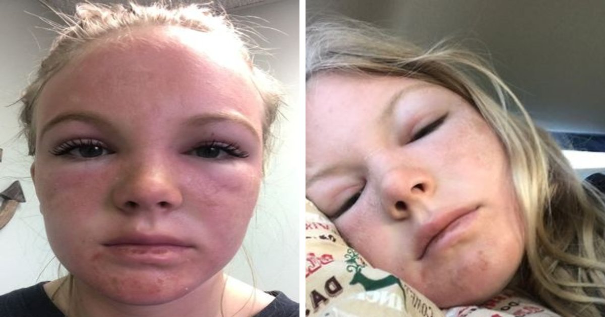 81.png?resize=412,275 - BREAKING: Woman Falls Asleep On Beach And Suffers Serious Case Of 'Sun Poisoning'