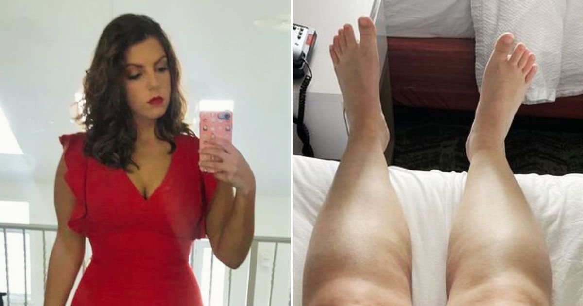 alisa4.jpg?fit=1024%2C538&ssl=1&strip=all - 28-Year-Old Woman Had More Than 6 LITERS Of Fluid Drained From Her Body After She Discovered She Had A Rare Condition