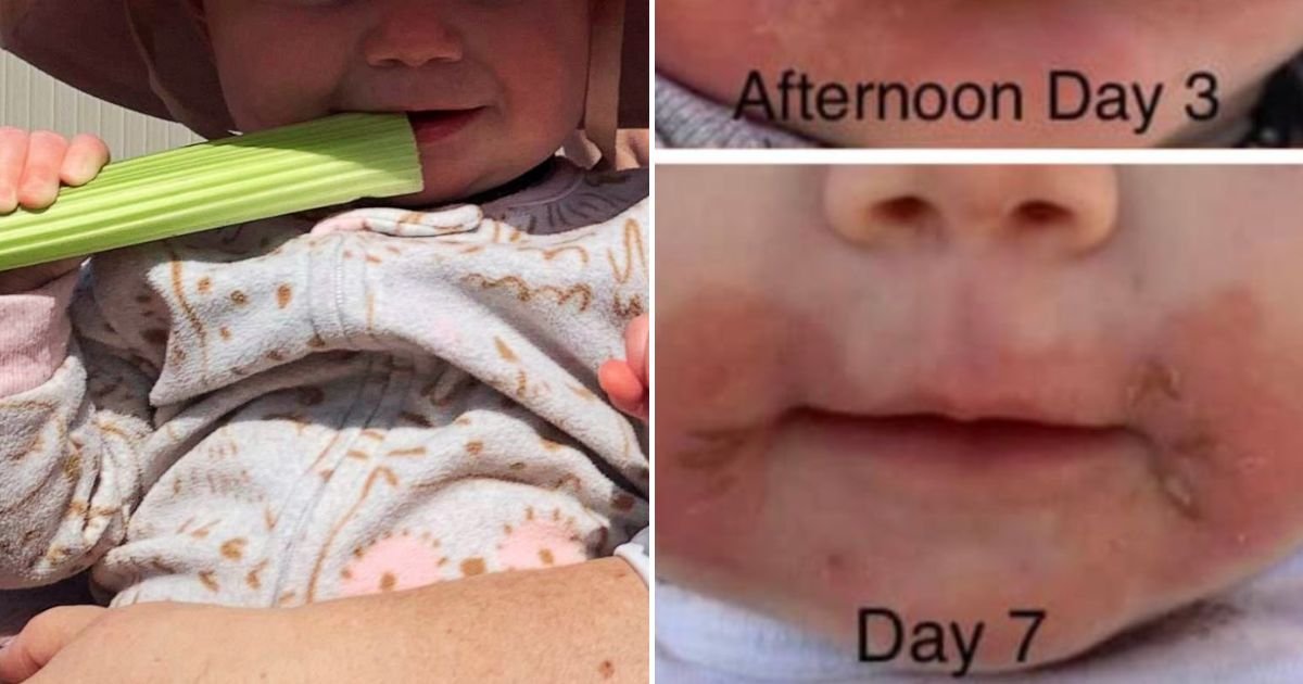 celery4.jpg?resize=412,275 - Mother Issues Desperate WARNING After Baby Developed Painful Burns Around Her Mouth When Eating Celery Sticks