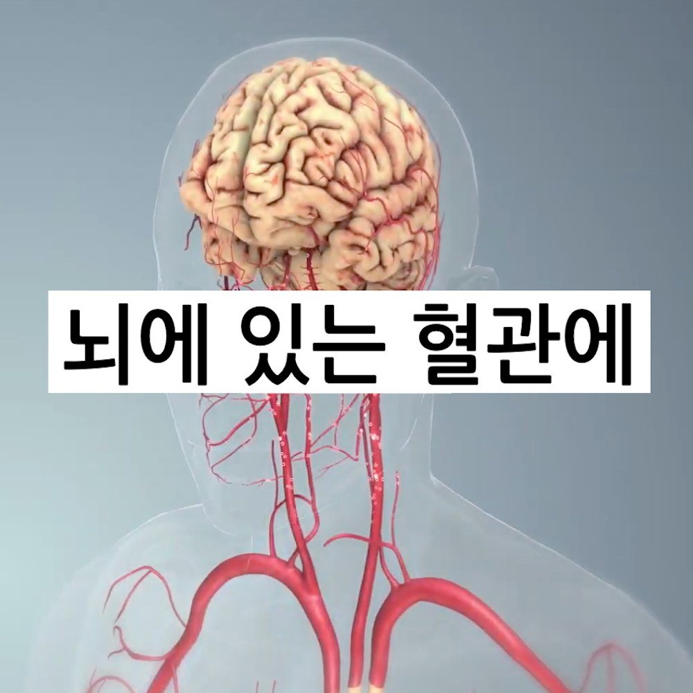 5 .jpg?resize=412,232 - 뇌 혈전 실제로 제거 모습 ㄷㄷ