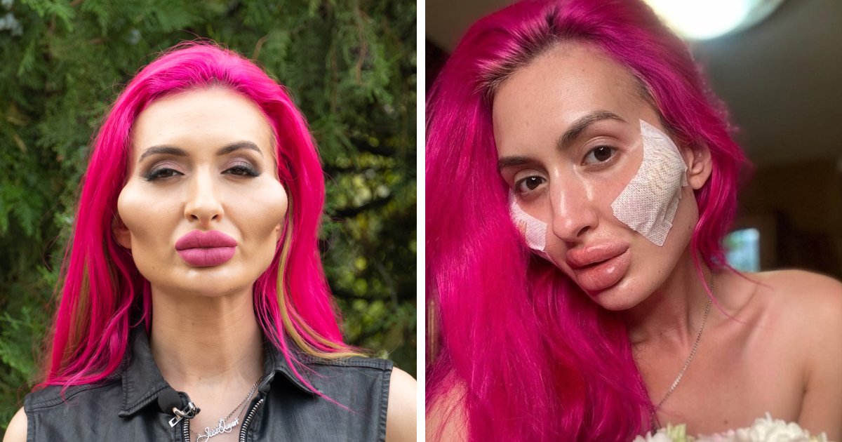 t4 14.png?resize=412,275 - JUST IN: Model With World's 'Biggest Cheeks' Sparks Concern As She Undergoes Surgery Again