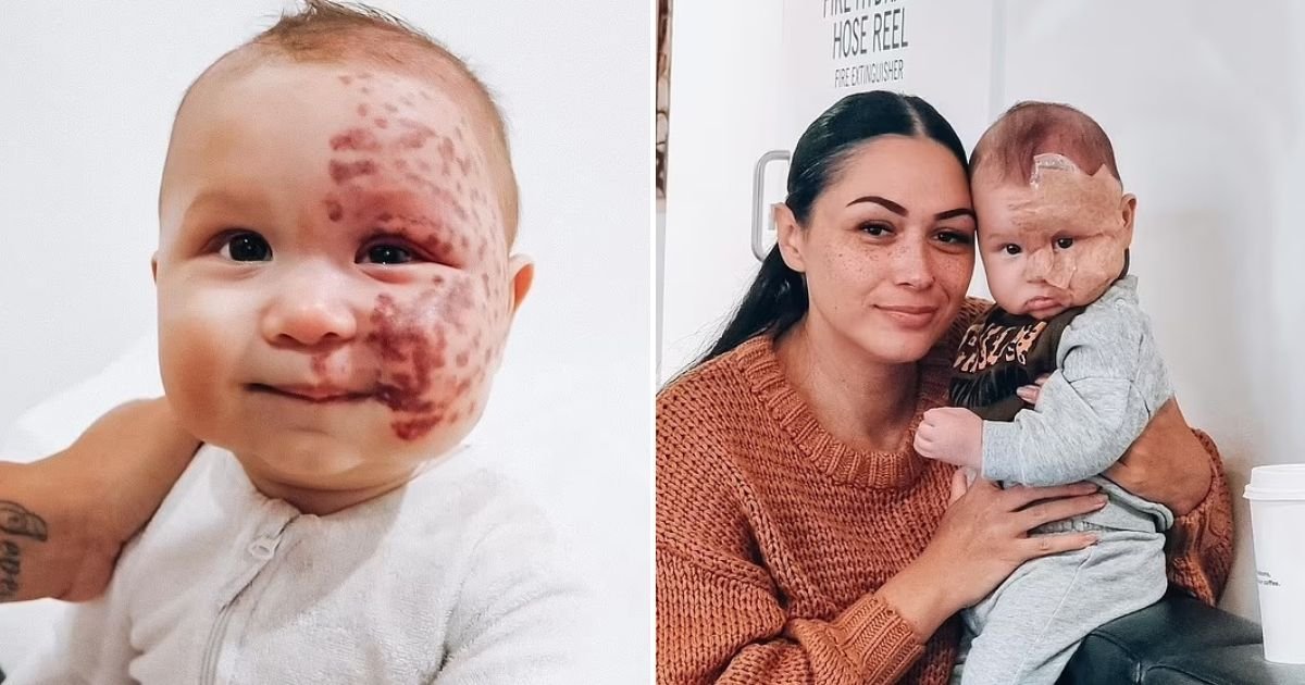 untitled design 16.jpg?fit=1024%2C538&ssl=1&strip=all - Mom Who Was Accused Of Being A Monster For Lasering Baby's Birthmark Shares NEW Photos Of Her Child