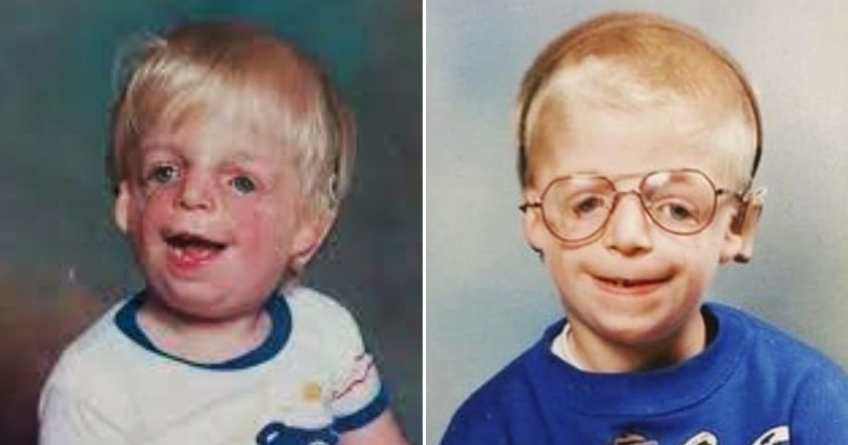 jono5.jpg?fit=1024%2C538&ssl=1&strip=all - 'My Parents Abandoned Me After They Saw My Face, Years Later I Tried To Get In Touch But They Rejected Me All Over Again'