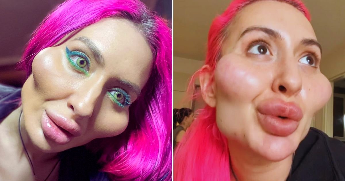 ana5.jpg?fit=1024%2C538&ssl=1&strip=all - Woman With The 'World's BIGGEST Cheeks' Reveals That She Is Now Ready For Another Treatment Following A Visit To Gynecologist