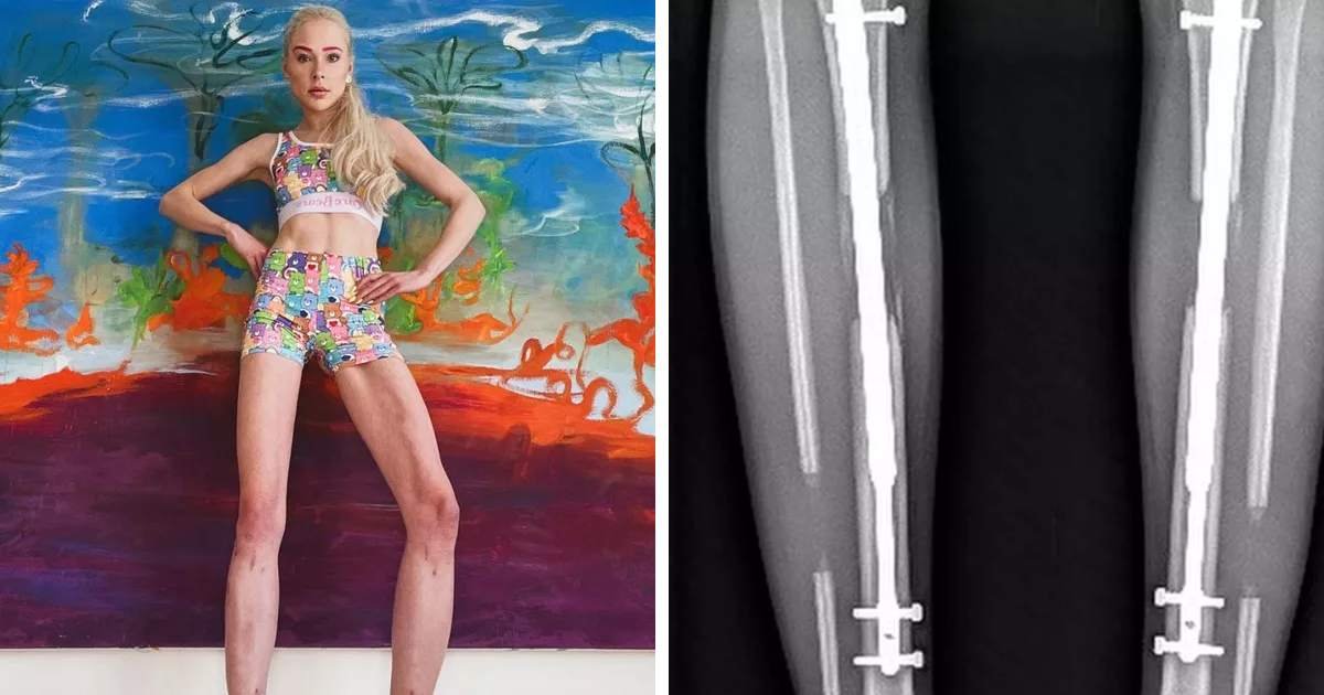 t7.jpeg?resize=1200,630 - Woman Who Paid $165k For 'Extended Legs' Says She's Now Living A 'Life Full Of Regrets'