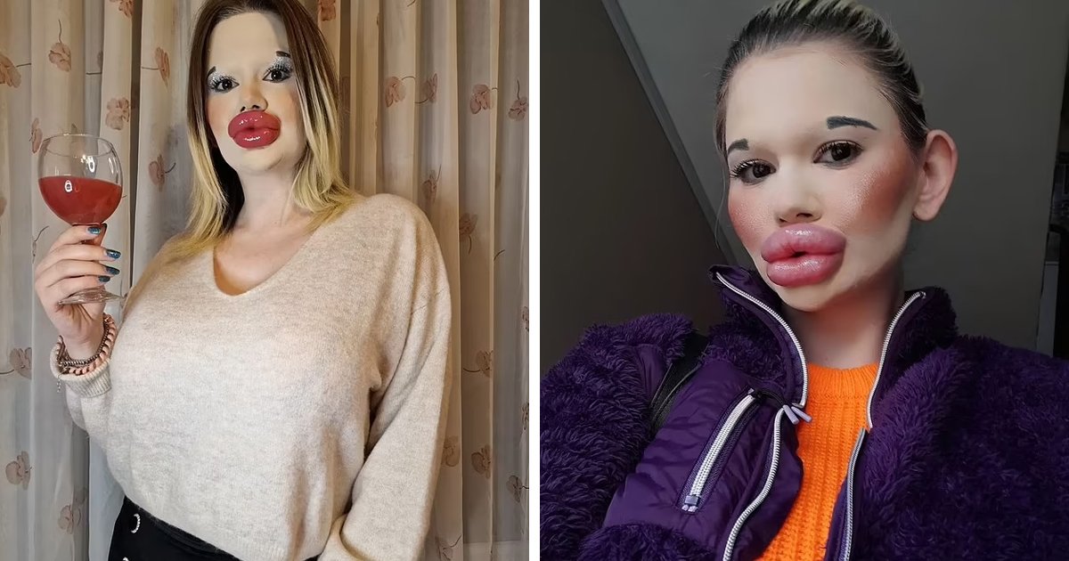 d59.jpg?resize=1200,630 - Woman Who Spent Thousands To Get World’s Biggest Lips Is Now Spending More To Get World’s Biggest Cheekbones