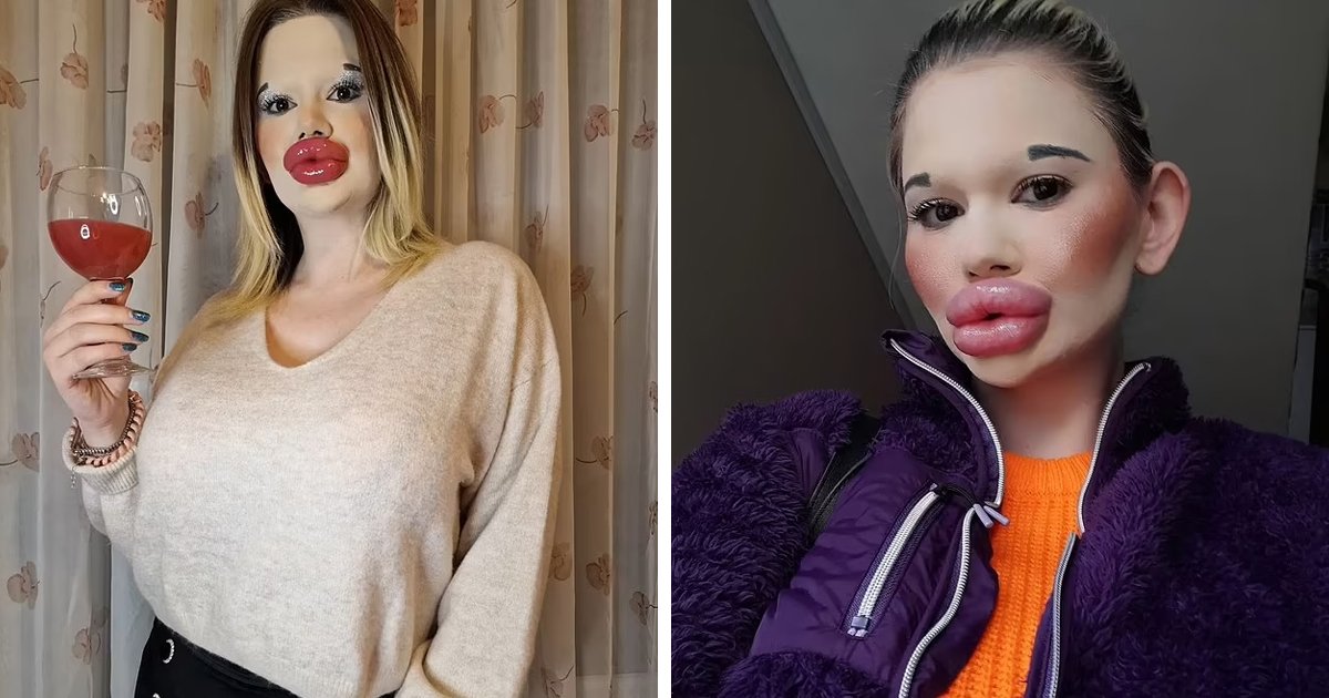 d59.jpg?resize=412,275 - Woman Who Spent Thousands To Get World’s Biggest Lips Is Now Spending More To Get World’s Biggest Cheekbones