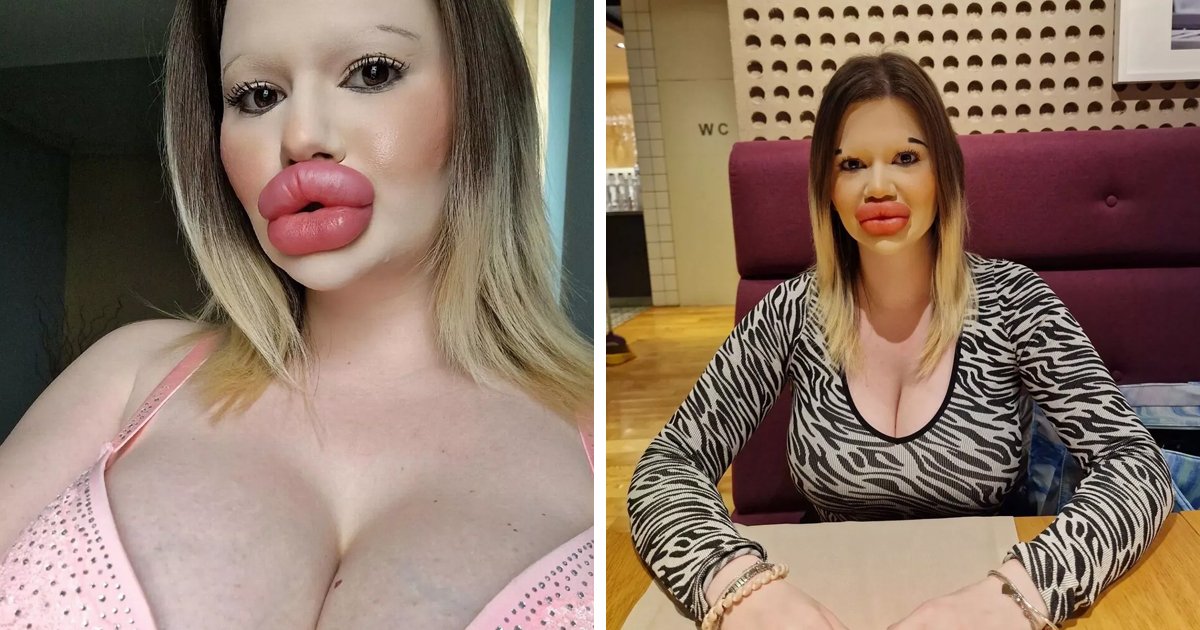 d77.jpg?resize=412,232 - JUST IN: Woman With ‘World’s Biggest Lips’ Gets WARNING That ‘They’ll Burst’ As She Gets More Fillers