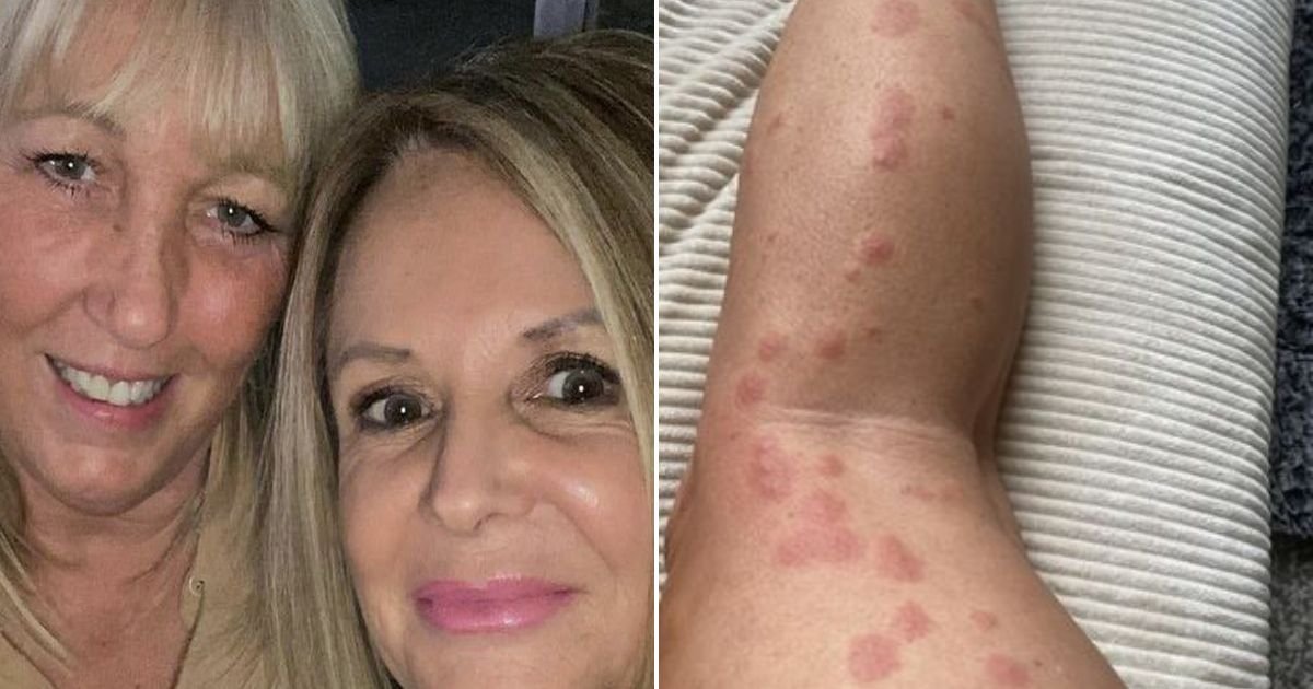 untitled design 2023 10 14t121146 133.jpg?resize=412,232 - Woman Left Horrified After Waking Up With Over TWO HUNDRED Bites All Over Her Body
