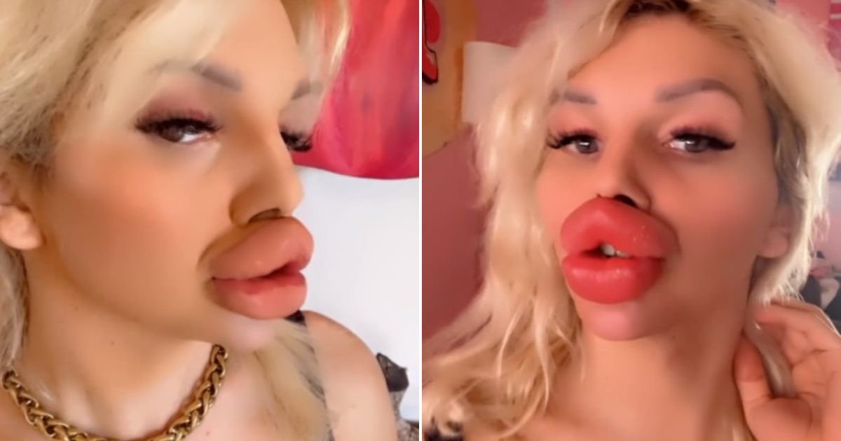 untitled design 2023 10 26t193803 922.jpg?fit=1024%2C538&ssl=1&strip=all - 'I've Had So Many Fillers I Can't Drink Properly Anymore – But I Want My Lips To Be Even BIGGER'