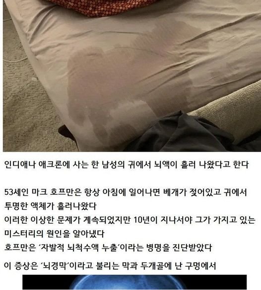 3 19.jpg?resize=1200,630 - 10년간 귀에서 나온 액체의 정체 ㄷㄷ