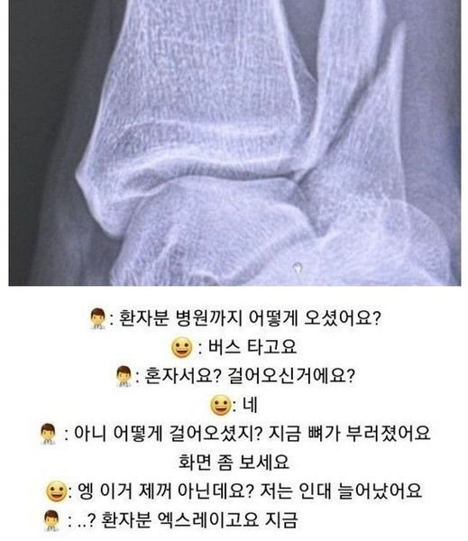 5 18.jpg?resize=412,232 - 발목 부러졌는데 하나도 안아프다는 여자의 11개월 뒤 근황