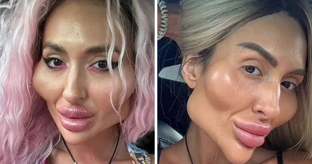 copy of articles thumbnail 1200 x 630 7 9.jpg?resize=1200,630 - Woman With 'World's Biggest Cheeks' Reveals What She Looked Like Before Spending Massively On Fillers