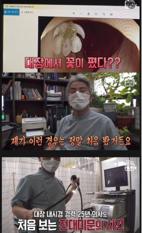 9 7.png?resize=1200,630 - 대장내시경 중 몸 안에서 발견된 것