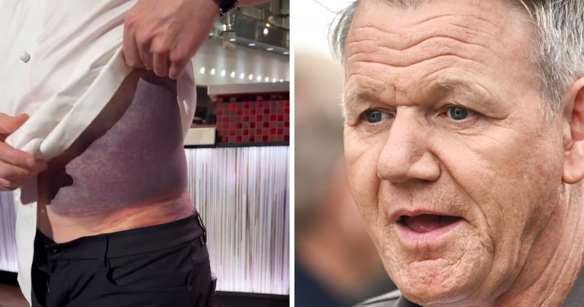 copy of articles thumbnail 1200 x 630 10 6.jpg?resize=1200,630 - Gordon Ramsay Shows Off Horrific Bruise on Torso and Fans are Stunned After Finding Out What Caused It