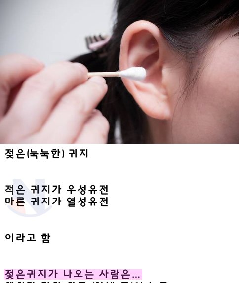 2 6.png?resize=1200,630 - 한국사람은 거의 없다는 귀지 타입ㄷㄷ