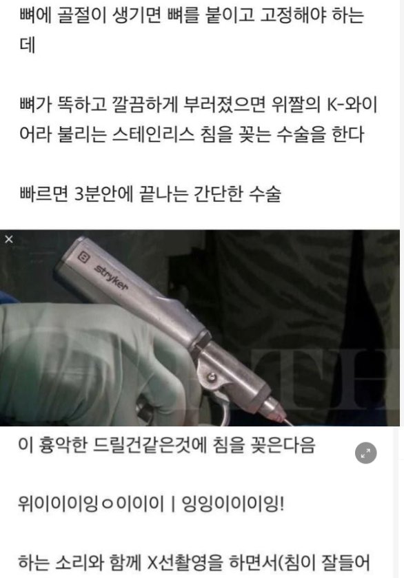 8 21.png?resize=1200,630 - 뼈가 부러지기 전에는 의외로 모르는 사실