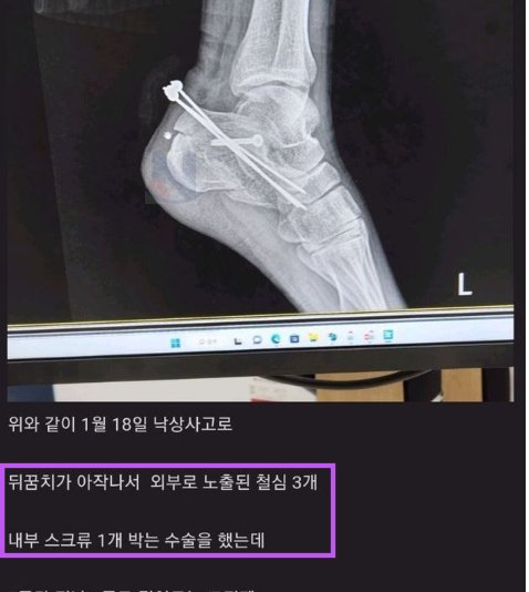 8 30.png?resize=412,232 - 철심이 불편하다고 집에서 '셀프'로  철심 빼버린 사람.