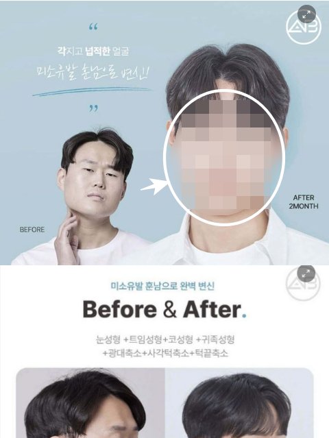 2 48.png?resize=412,275 - 요즘 남자 성형수술 근황.jpg..