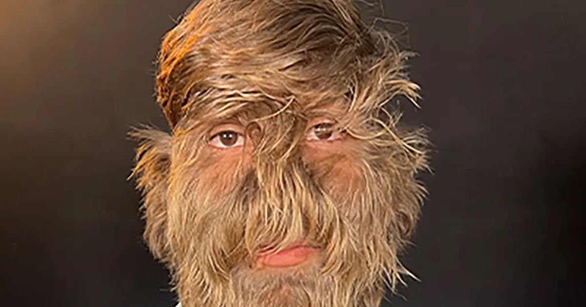 copy of articles thumbnail 1200 x 630 8 2.jpg?resize=412,232 - Teen Sets Record for Hairiest Face in the World — With 95% of It Covered