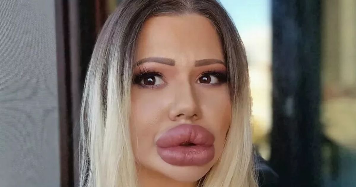 copy of articles thumbnail 1200 x 630 2025 07 04t205854 742.jpg?resize=1200,630 - Woman with World's Biggest Lips Is In SEVERE Pain But Doctors REFUSE To Touch Her