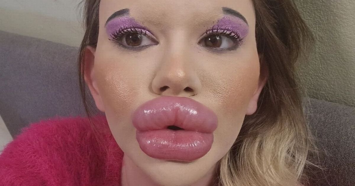 copy of articles thumbnail 1200 x 630 2025 07 28t033111 463.jpg?resize=412,232 - Woman With 'World's Biggest Lips' Reveals Her Face Before Surgery