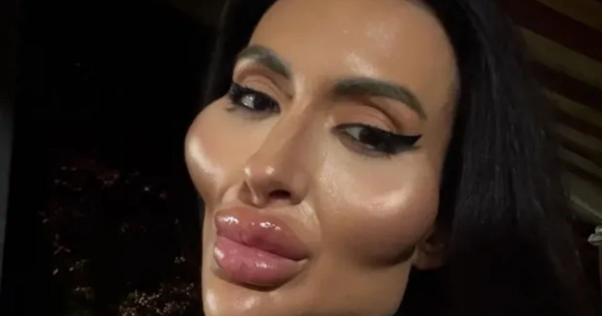 copy of articles thumbnail 1200 x 630 2025 09 17t145621 040.jpg?resize=412,232 - Woman spends 10 years getting the ‘world’s biggest cheeks’ – now her ‘before’ photos are shocking the internet