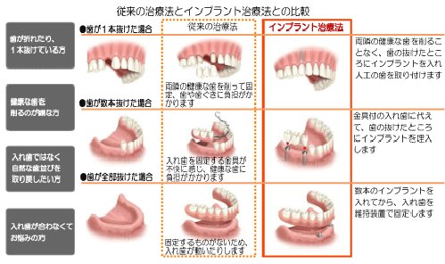 芸能人の歯　インプラント